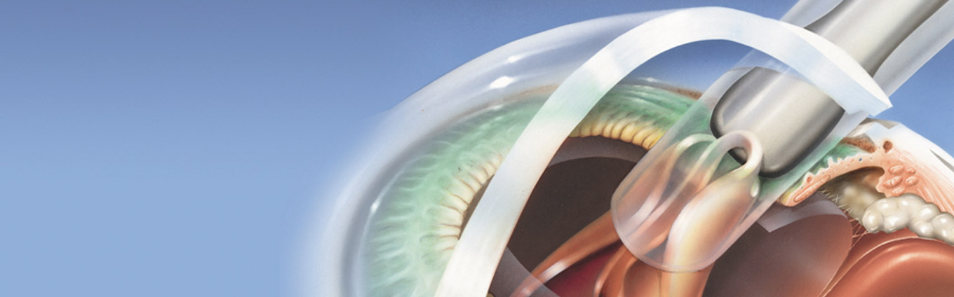 Cataract Technology (IOLs)