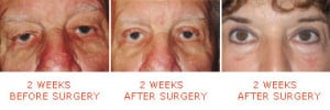 Eyelid Surgery Culpeper, VA