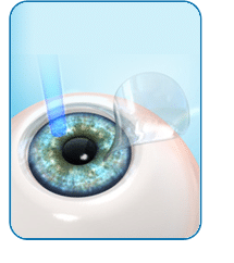 Laser Eye Surgery Fredericksburg, VA