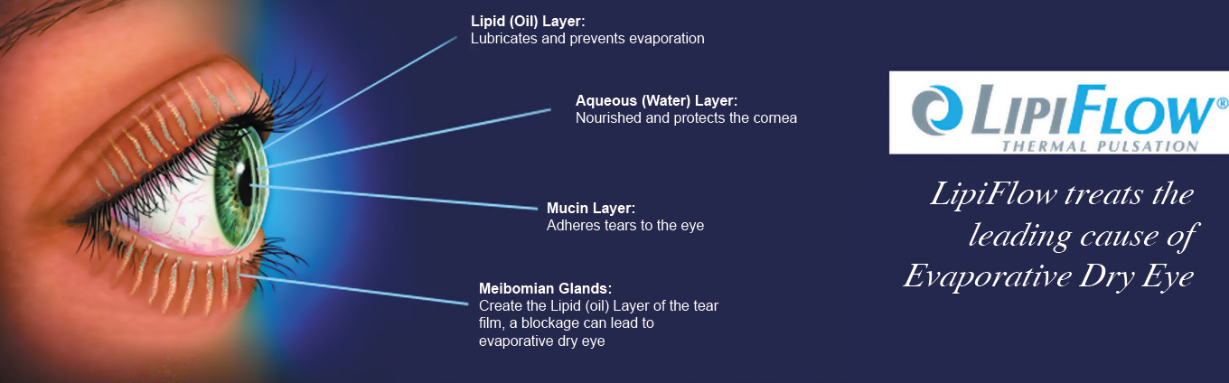 LipiFlow® Thermal Pulsation System: A New Dry Eye Treatment for MGD