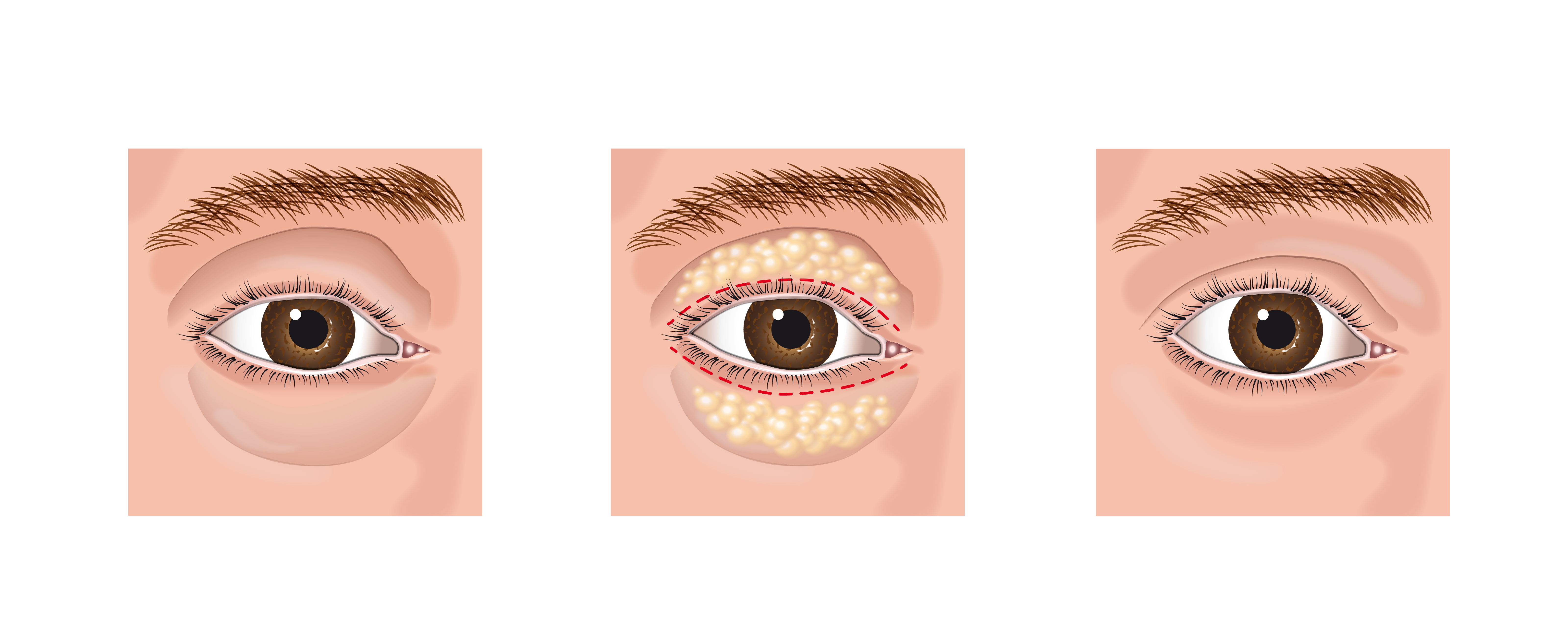 Eyelid Rejuvenation—Look better, See Better