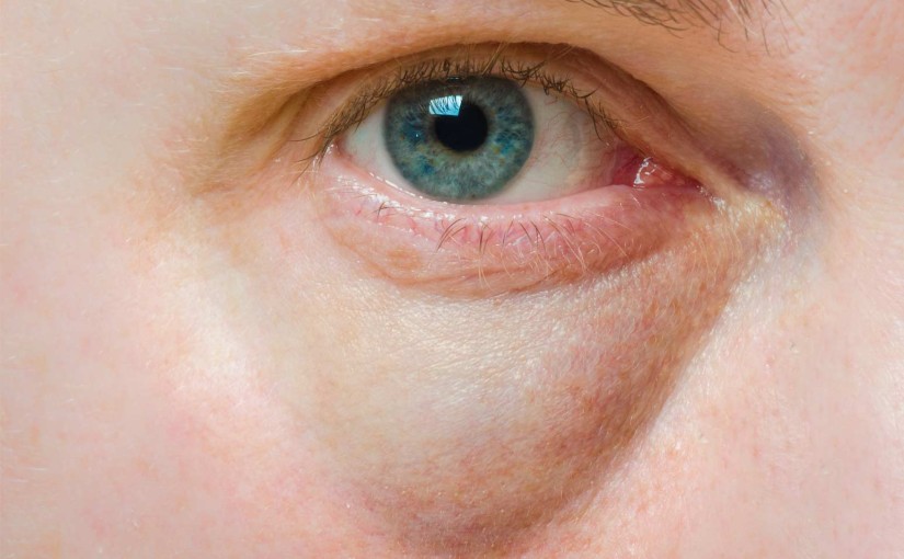 Puffy Eyes: Causes and Remedies