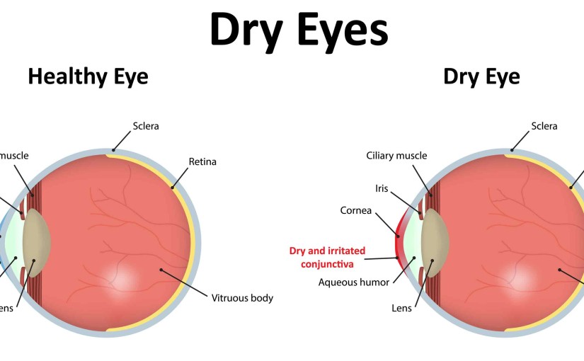 dry eyes, ophthalmologists, Vista Eye Specialists, Culpeper, Fredericksburg