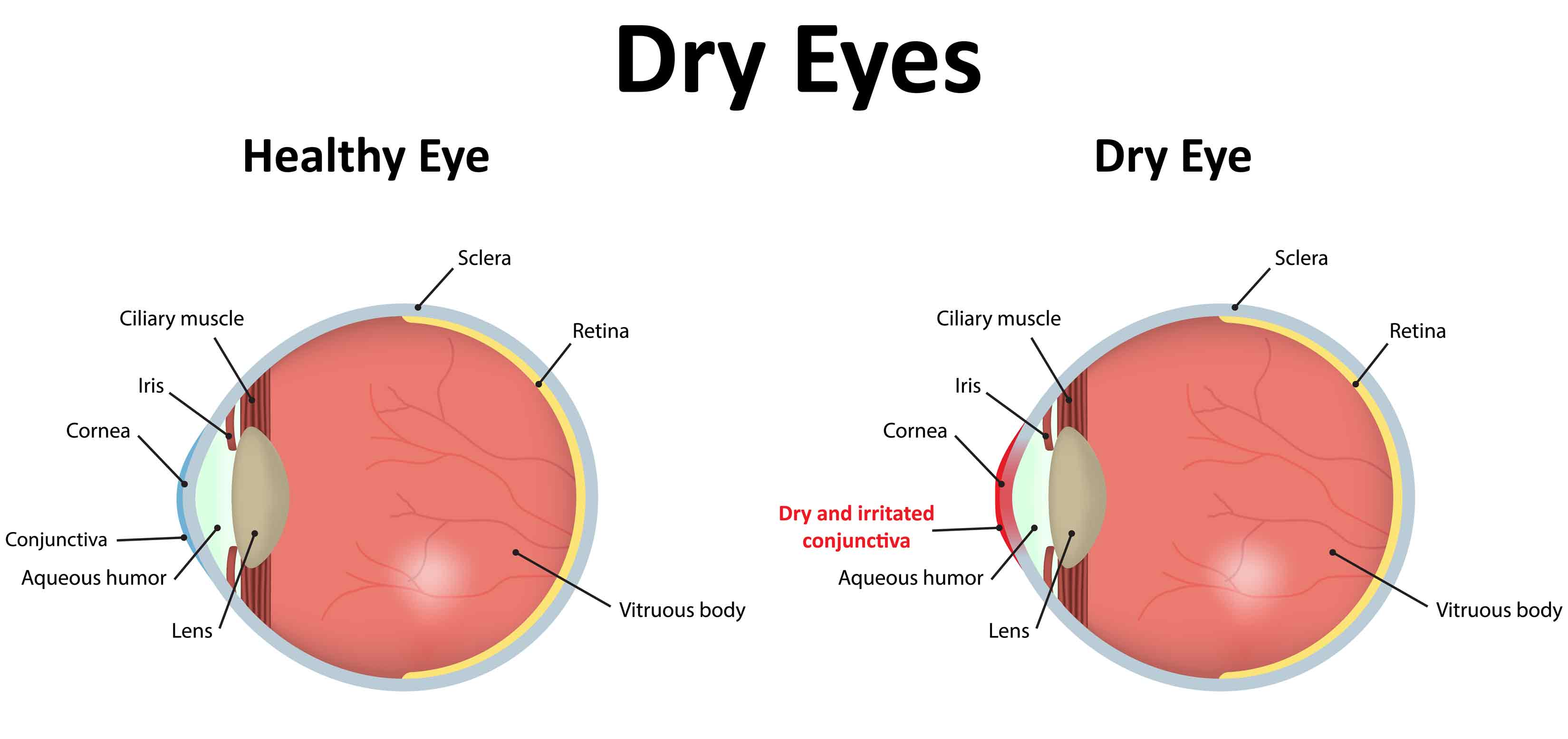 Watch out for Dry Eyes in Winter