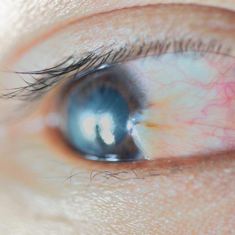 What Is Pterygium? Vista Eye Specialists