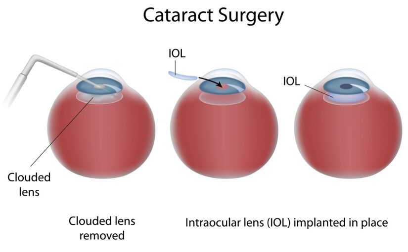 Cataract Surgery in Fredericksburg