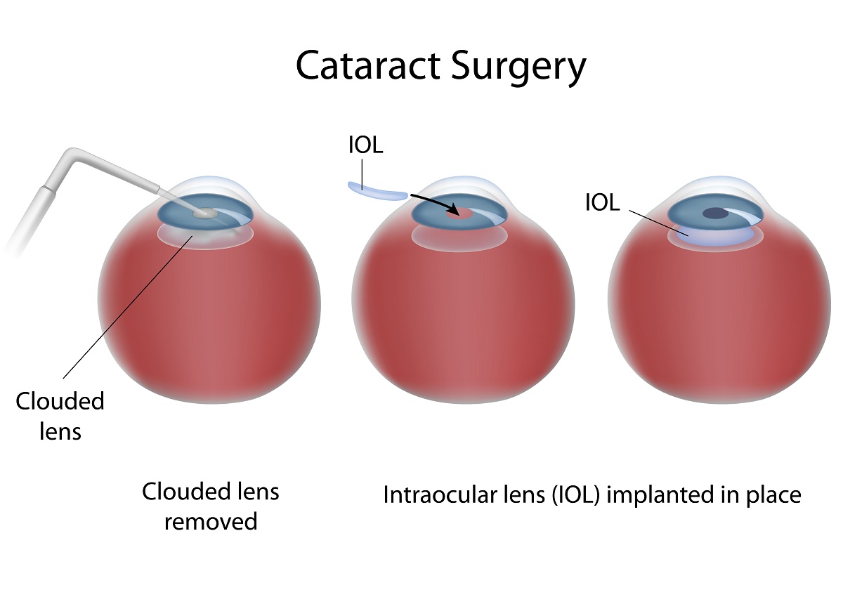 Cataract Facts That Might Surprise You