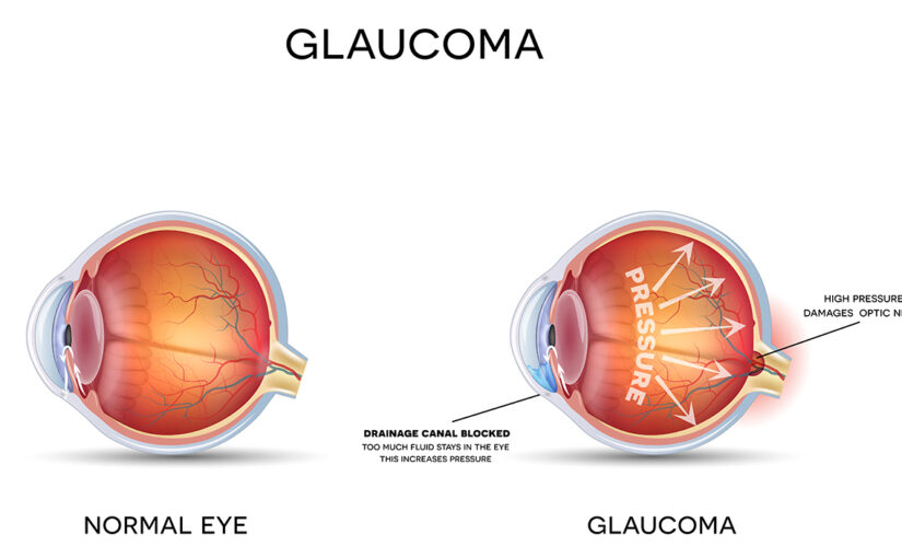 Glaucoma Treatment in Fredericksburg, VA