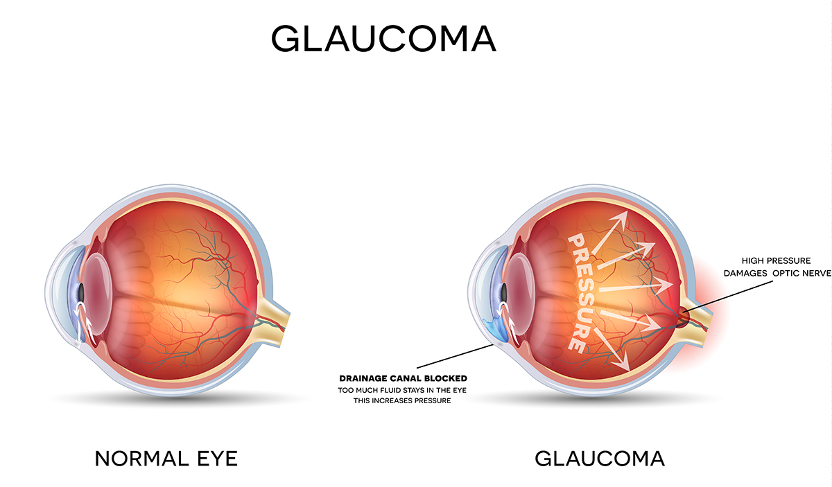 Discover Your Risk of Developing Glaucoma During Awareness Month