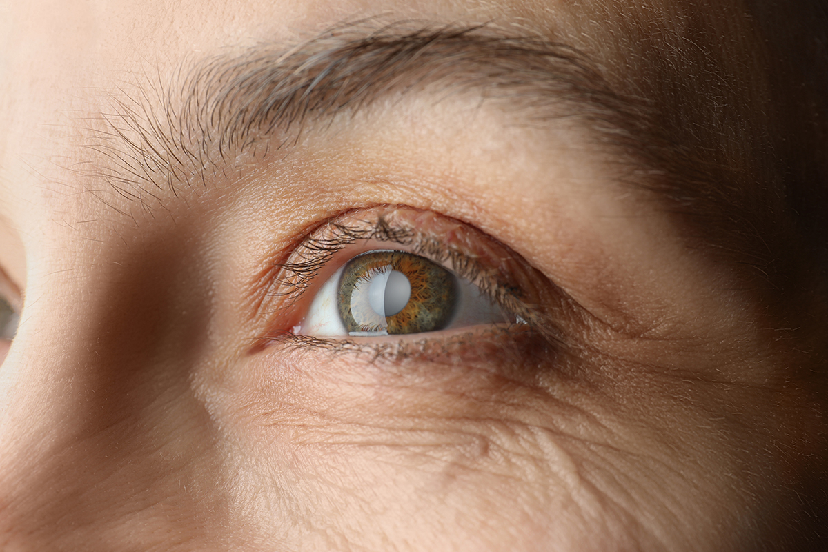3 Benefits of Laser Cataract Surgery Over the Traditional Procedure