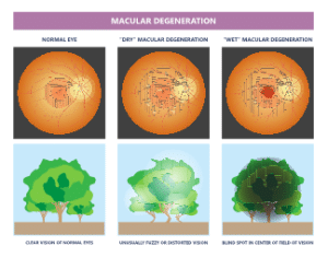 Macular Degeneration Treatment Fredericksburg VA