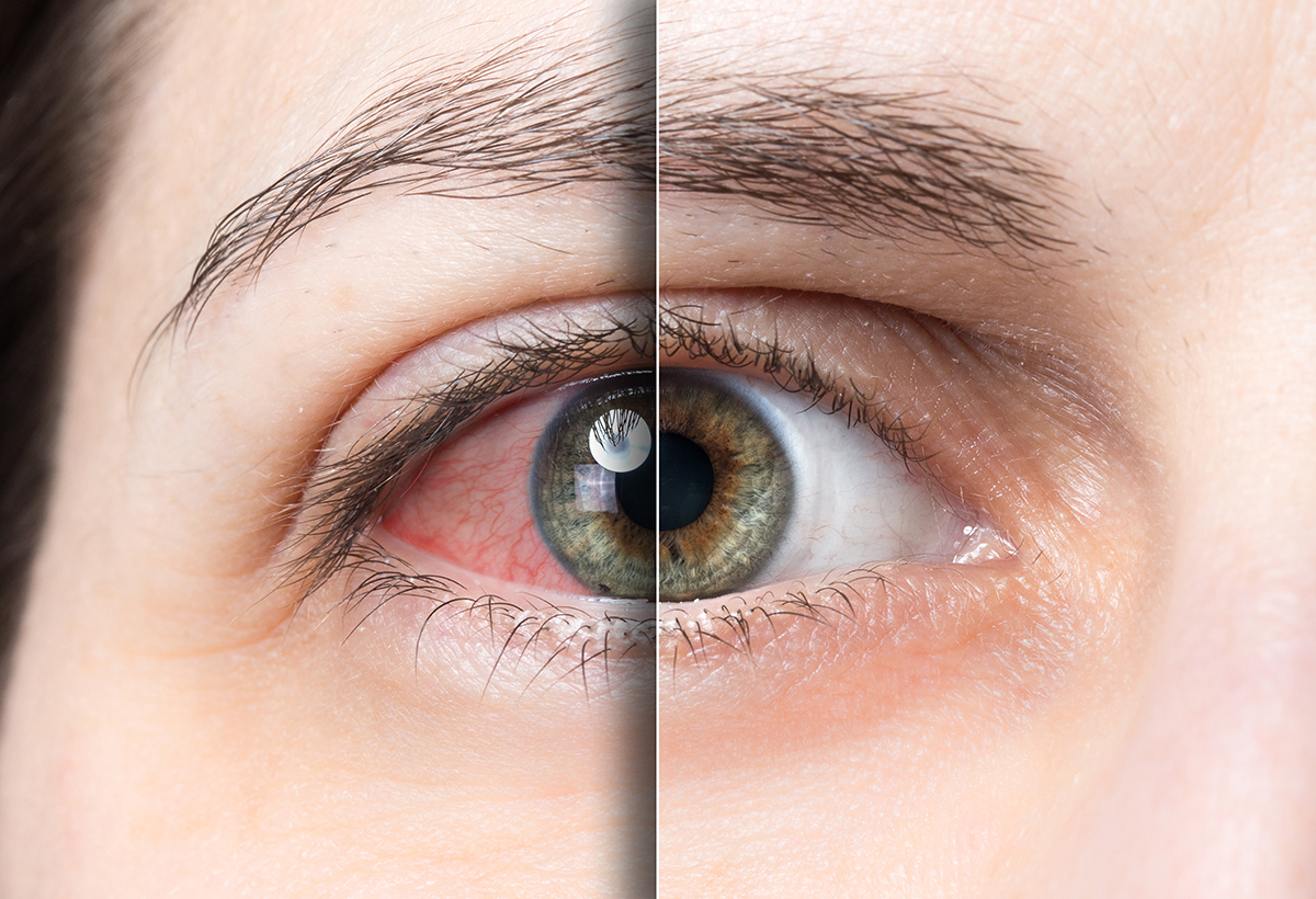 Dry Eyes Can Affect Your Quality of Life: These Treatments May Help