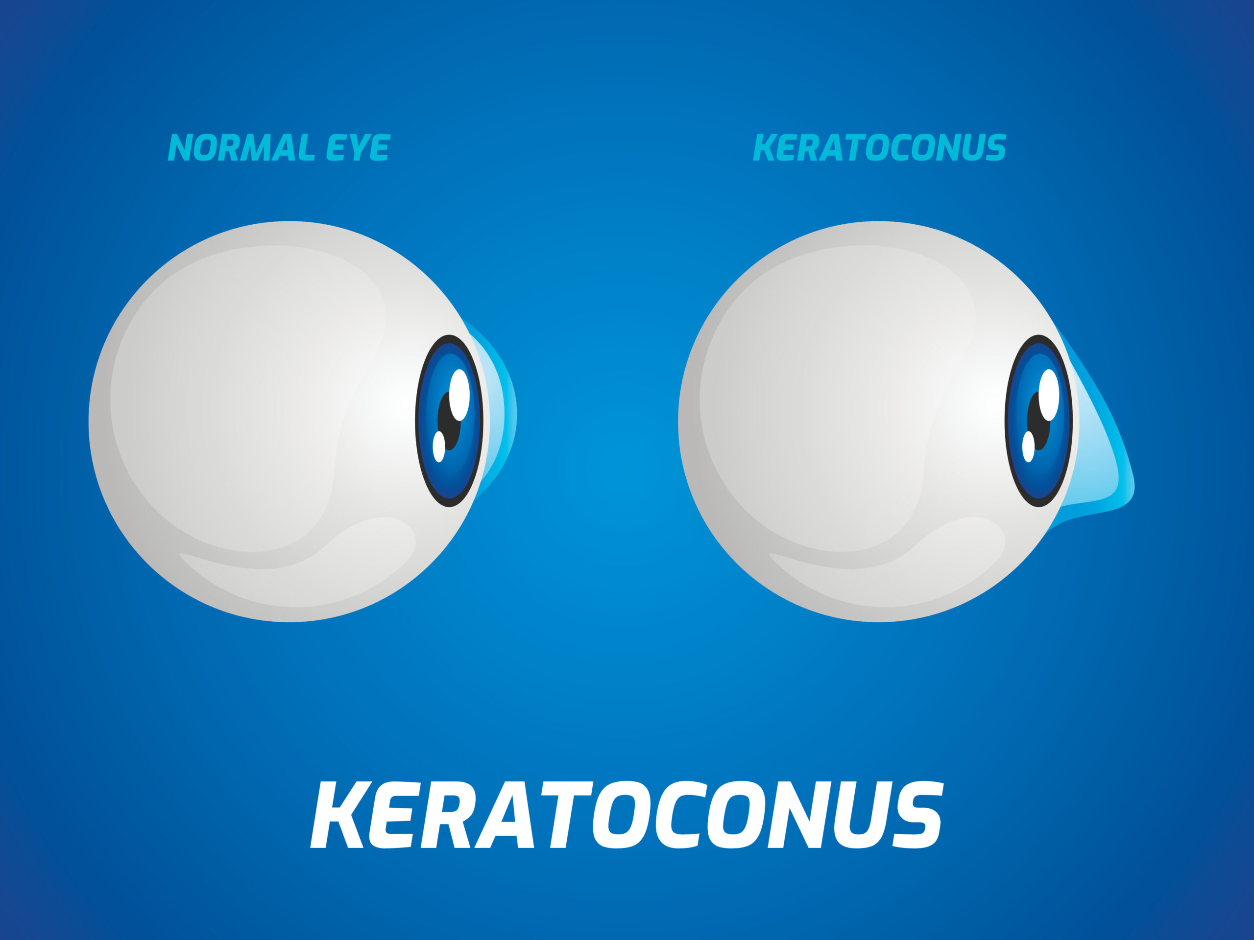 4 Frequent Misconceptions About Keratoconus