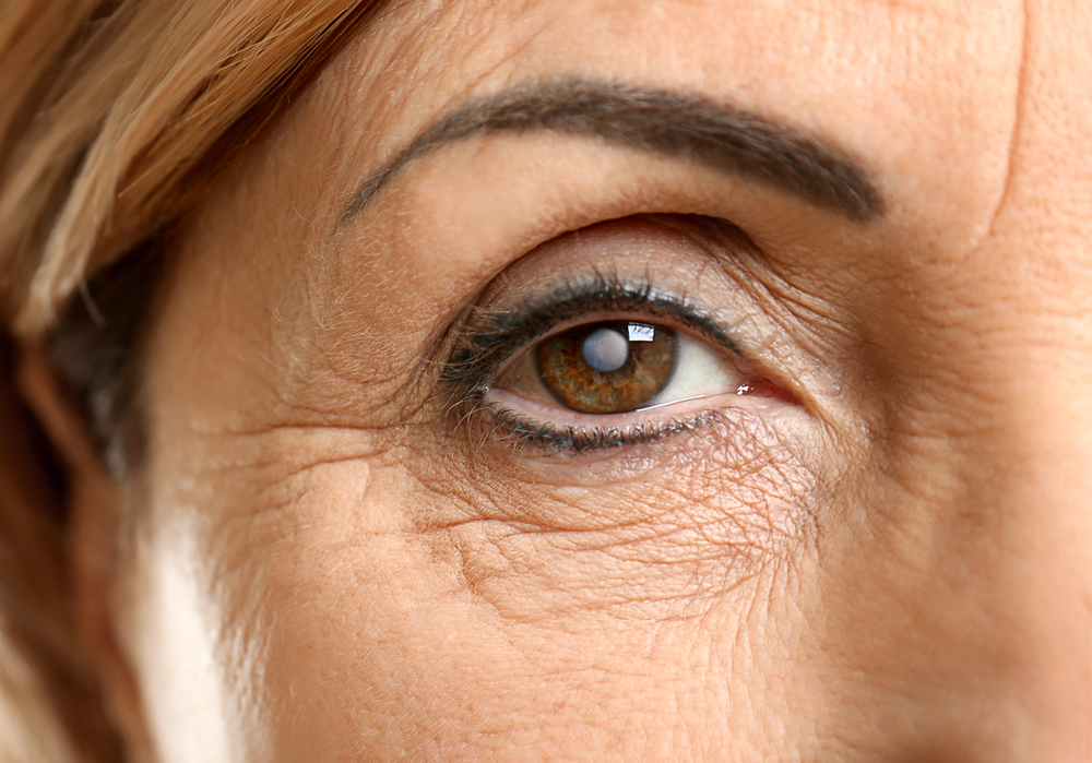 Do You Have Cataracts? Signs to Look Out For