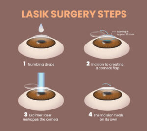 Laser Vision Correction in Culpeper 