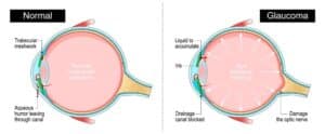 Glaucoma Treatment In Culpeper, VA